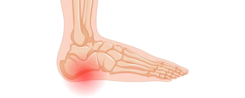 Plantarfasziitis